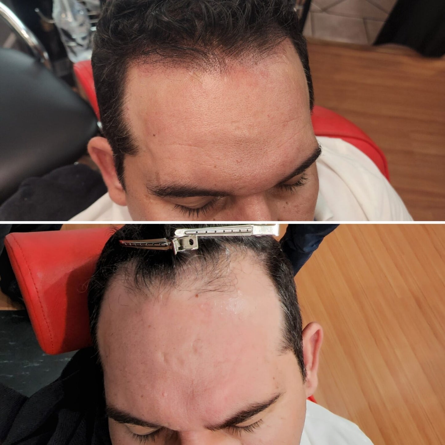 Scalp micropigmentation course